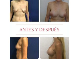 Aumento Mamas - Dra. Noelia Tarazona