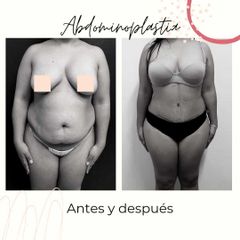 Abdominoplastia - Dra. Noelia Tarazona Duarte