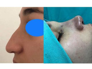 RINOPLASTIA