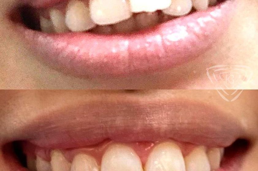 Ortodoncia invisible antes y después - 850231