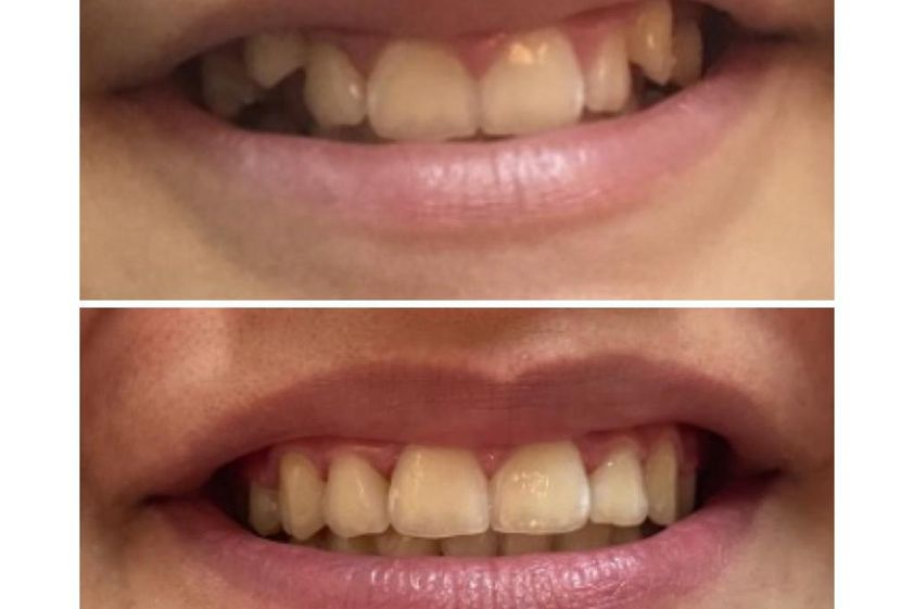 Ortodoncia invisible antes y después - 850232