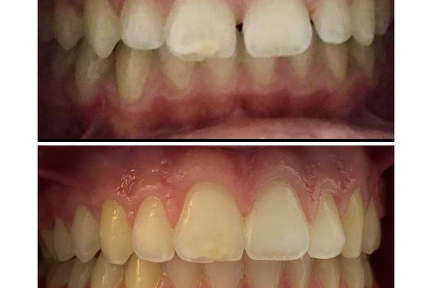 Ortodoncia invisible antes y después - 850236
