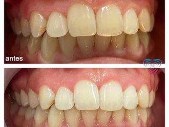 Blanqueamiento dental - 853268