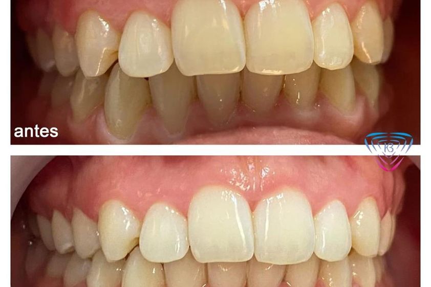 Blanqueamiento dental antes y después - 853268