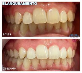 Blanqueamiento dental - Dra. Karina Biondi