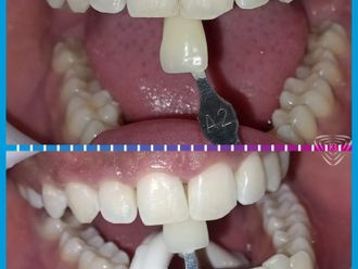 Blanqueamiento dental antes y después - 861107