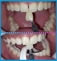 Blanqueamiento Dental - Dra. Karina Biondi