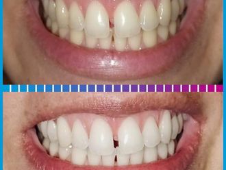 Blanqueamiento dental antes y después - 861108