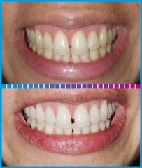 Blanqueamiento Dental - Dra. Karina Biondi