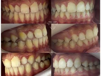 Ortodoncia antes y después - 861109