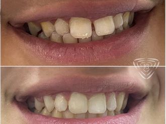 Ortodoncia antes y después - 861110