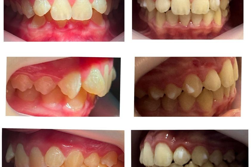Ortodoncia invisible antes y después - 875088
