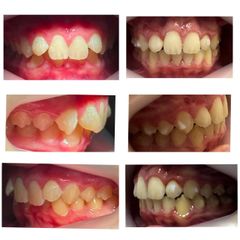Ortodoncia Invisible - Dra. Karina Biondi