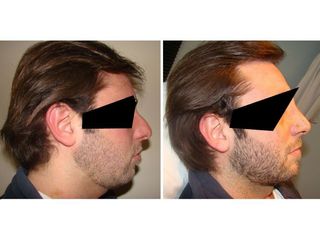 Rinoplastia - Dr. Gustavo Federico Costanzo