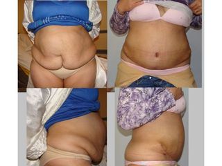 Abdominoplastia - Dr. Gustavo Federico Costanzo