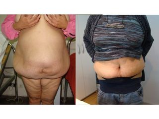 Abdominoplastia - Dr. Gustavo Federico Costanzo