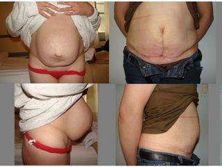 Abdominoplastia - Dr. Gustavo Federico Costanzo