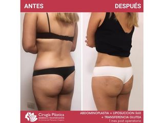 Aumento glúteos - Dr. Emmanuel Manavela Chiapero