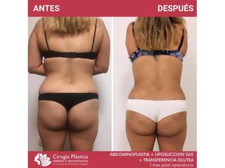 Liposucción - Dr. Emmanuel Manavela Chiapero