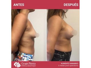 Aumento mamas - Dr. Emmanuel Manavela Chiapero