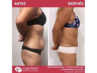 Abdominoplastia - Dr. Emmanuel Manavela Chiapero