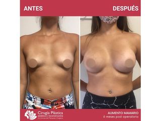 Aumento mamas - Dr. Emmanuel Manavela Chiapero