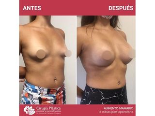 Aumento mamas - Dr. Emmanuel Manavela Chiapero