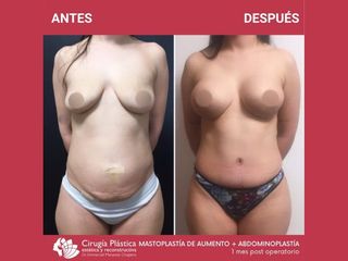 Abdominoplastia - Dr. Emmanuel Manavela Chiapero