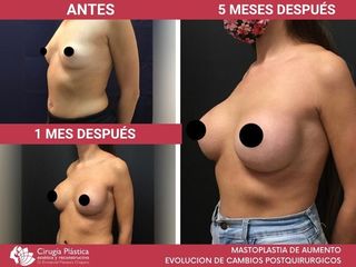 Aumento mamas - Dr. Emmanuel Manavela Chiapero