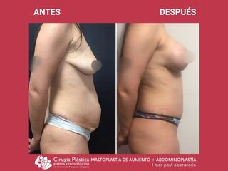 Aumento mamas - Dr. Emmanuel Manavela Chiapero