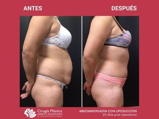 Abdominoplastia - Dr. Emmanuel Manavela Chiapero
