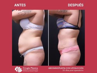 Abdominoplastia - Dr. Emmanuel Manavela Chiapero