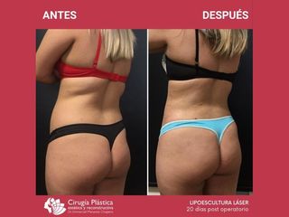 Lipoescultura - Dr. Emmanuel Manavela Chiapero