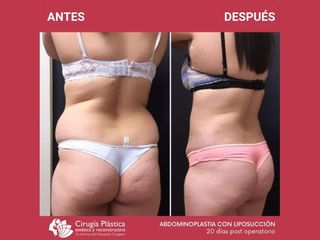 Liposucción - Dr. Emmanuel Manavela Chiapero