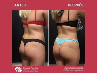 Lipoescultura - Dr. Emmanuel Manavela Chiapero