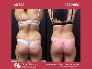 Liposucción - Dr. Emmanuel Manavela Chiapero