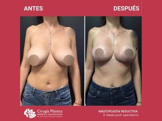 Reducción de mamas - Dr. Emmanuel Manavela Chiapero