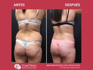 Liposucción - Dr. Emmanuel Manavela Chiapero