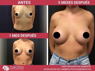 Aumento mamas - Dr. Emmanuel Manavela Chiapero