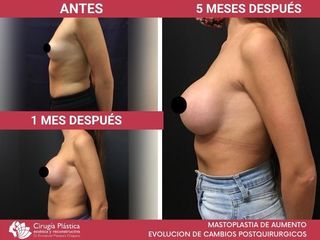 Aumento mamas - Dr. Emmanuel Manavela Chiapero