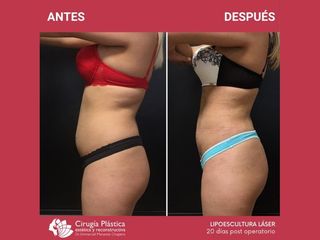 Lipoescultura - Dr. Emmanuel Manavela Chiapero