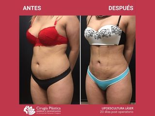 Lipoescultura - Dr. Emmanuel Manavela Chiapero
