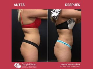 Lipoescultura - Dr. Emmanuel Manavela Chiapero