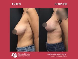 Reducción de mamas - Dr. Emmanuel Manavela Chiapero