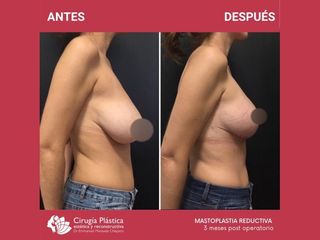 Reducción de mamas - Dr. Emmanuel Manavela Chiapero