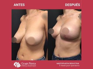 Reducción de mamas - Dr. Emmanuel Manavela Chiapero