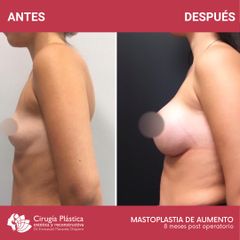 Aumento mamas - Dr. Emmanuel Manavela Chiapero