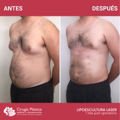 Lipoescultura - Dr. Emmanuel Manavela Chiapero