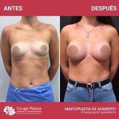 Aumento mamas - Dr. Emmanuel Manavela Chiapero