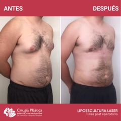 Lipoescultura - Dr. Emmanuel Manavela Chiapero